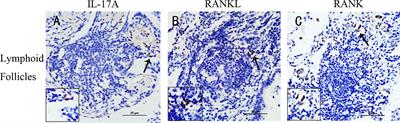 Cigarette Smoke-Induced Lymphoid Neogenesis in COPD Involves IL-17/RANKL Pathway